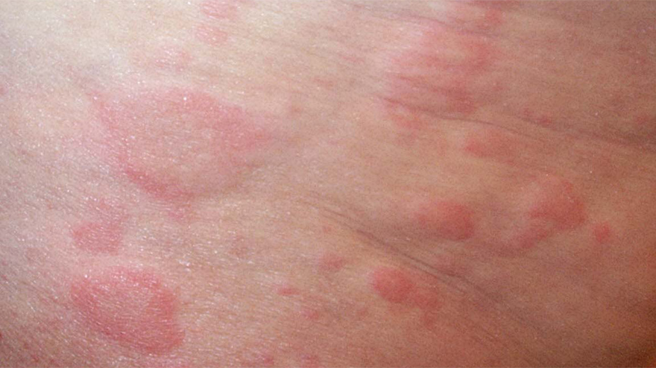 동물 비듬 두드러기 증상 및 치료
(Animal dander hives symptoms and treatment)