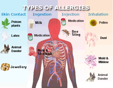 인간 알레르기 동물: 증상 원인 및 치료
(Human Allergic Animals: Symptoms Causes and Treatment)