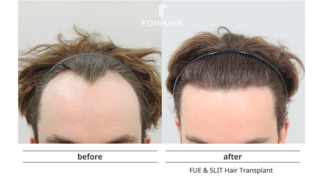 한국 모발이식 비용 확인 (Korean hair transplant cost)