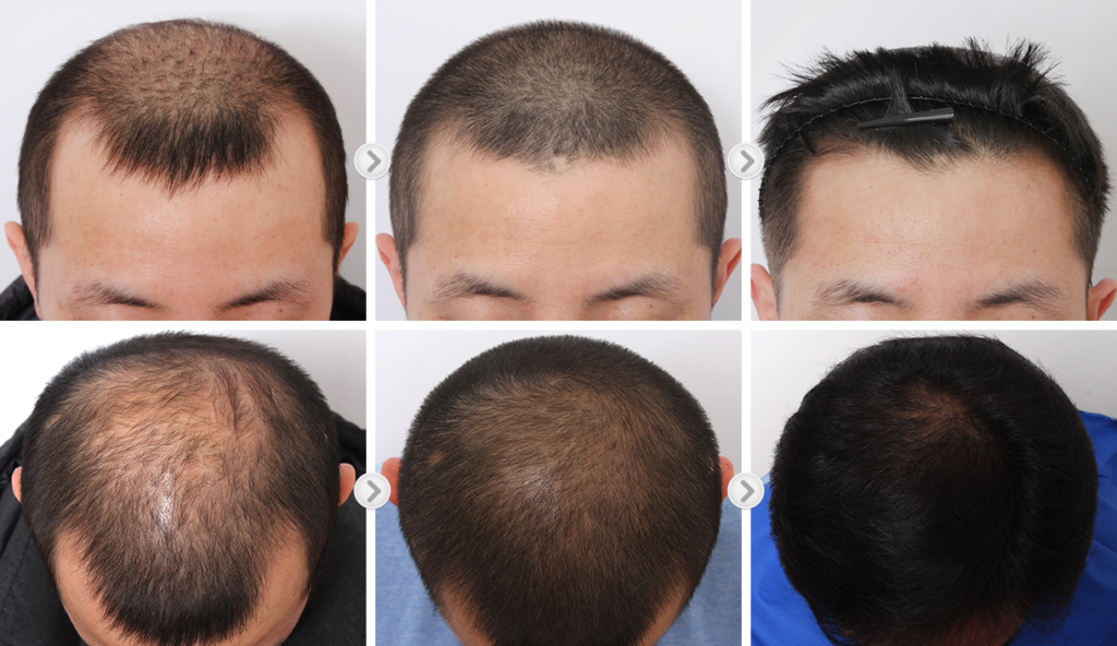 한국 헤어 성장 치료: 효과적인 탈모 솔루션 (Korean hair growth treatment: Effective hair loss solution)