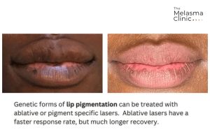 안티에이징 립 트리트먼트 효과적인 관리법
(Anti-aging lip treatment effective management method)