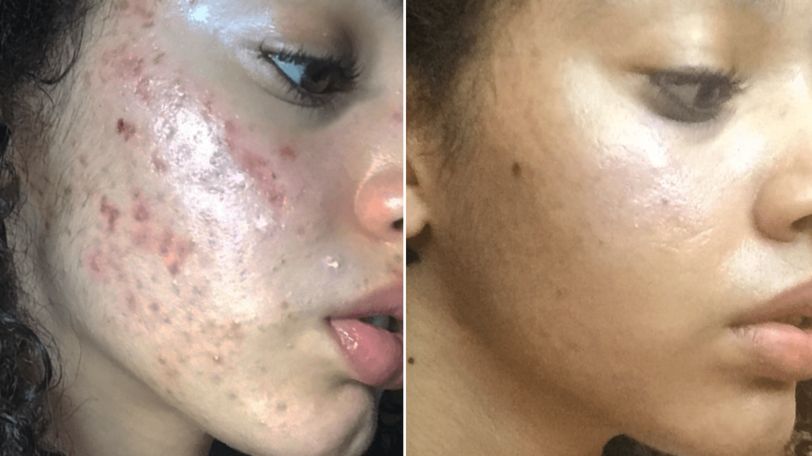 여드름 천연 스킨케어로 깨끗한 피부
(Yeodeureom cheonyeon seu Kinkeeolo kkaekkeutan pibu)

Translation: Acne natural skincare for clear skin