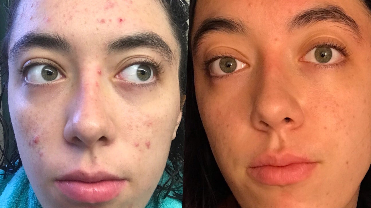 트레티노인 안티에이징 효과 있나요? (Is tretinoin anti aging effective?)
