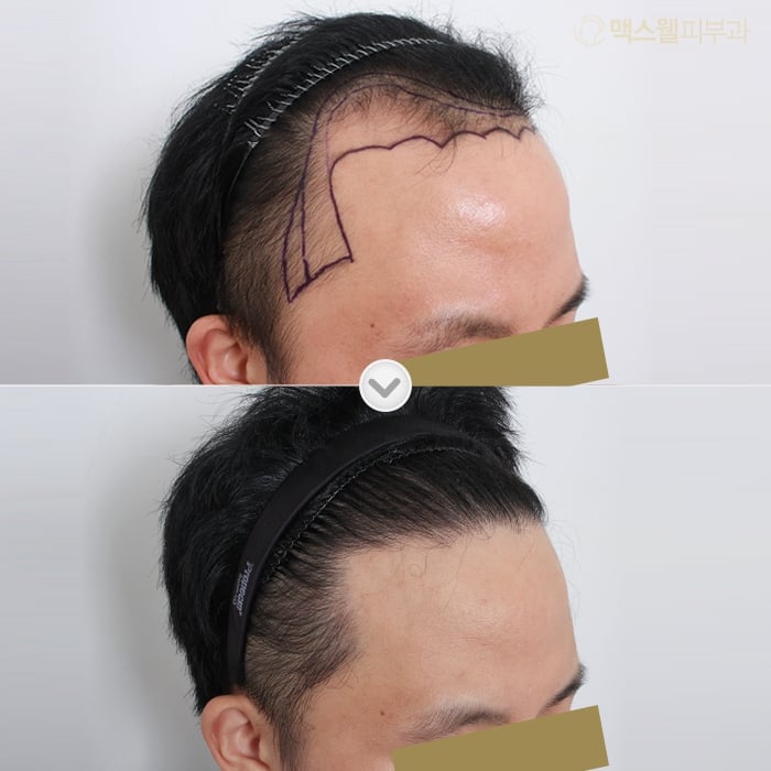 한국 모발이식 자연스러운 결과
(Korean hair transplant natural results)