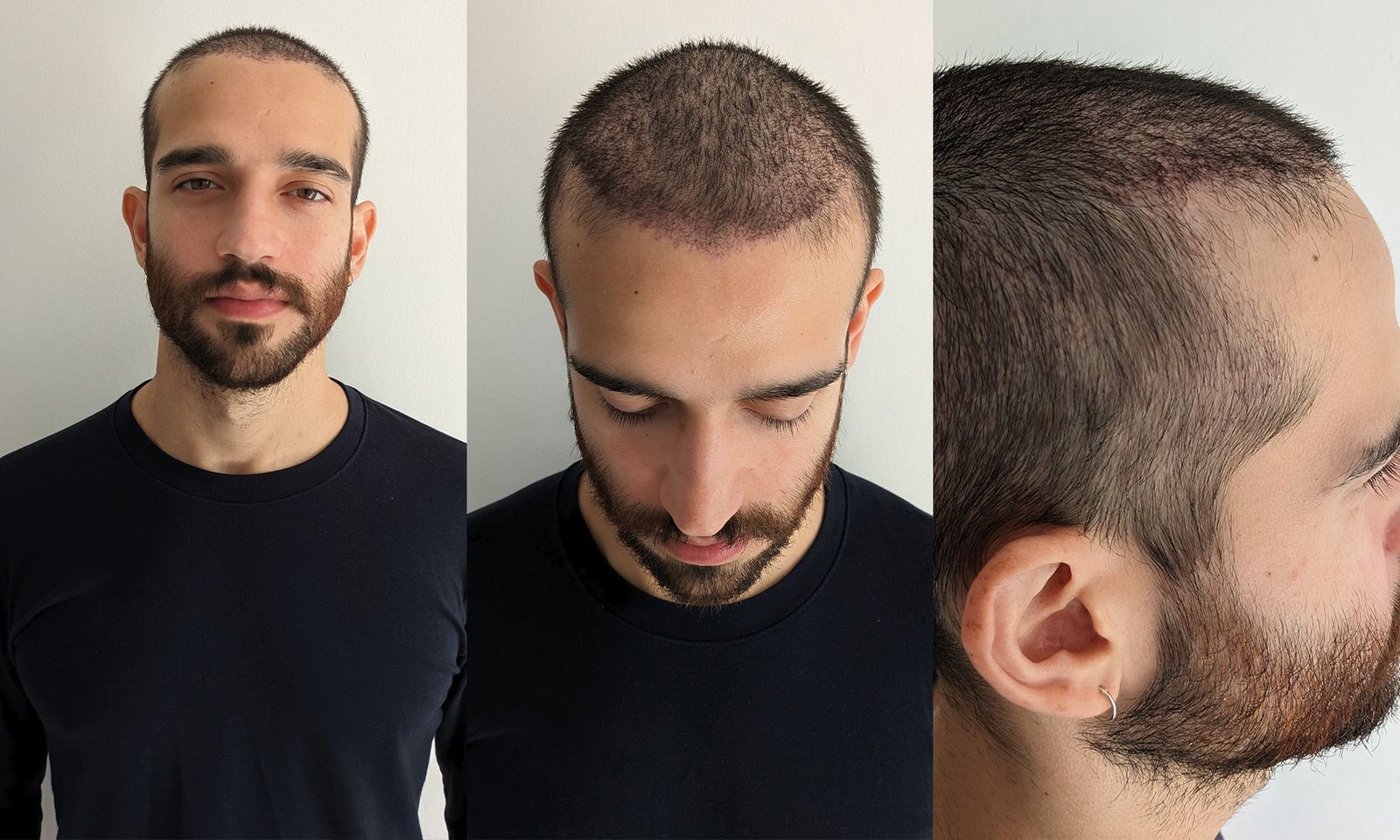 헤어스타일 헤어이식 자연스러운 결과
(Hair styles hair transplant natural results)