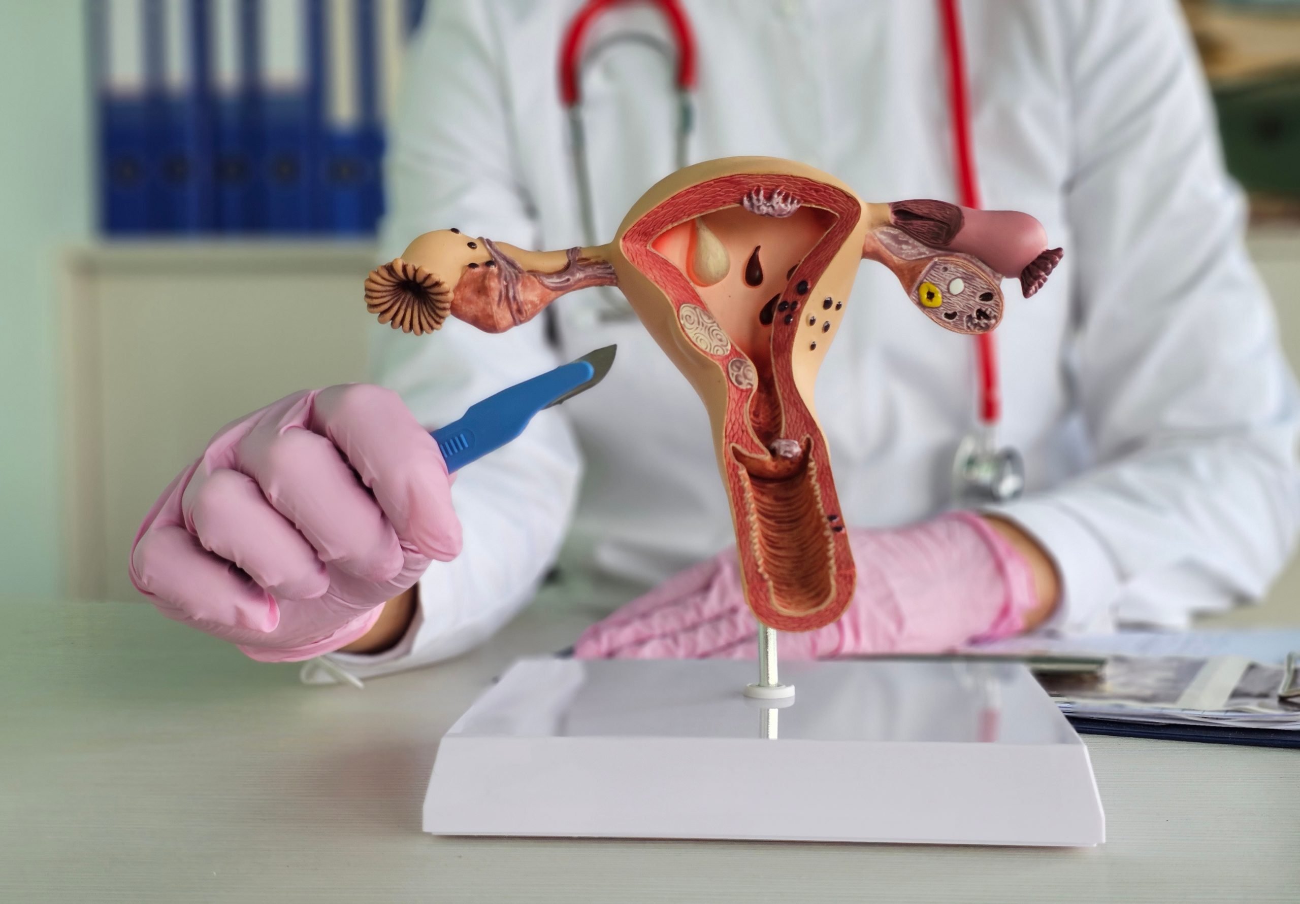 자궁탈출 수술 후 회복: 솔직하고 필터링되지 않은 계정